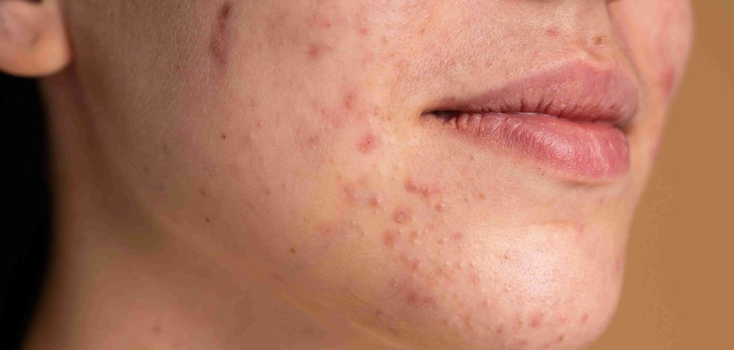 Pueraria Mirifica for Skin Pigmentation