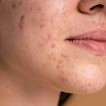 Pueraria Mirifica for Skin Pigmentation