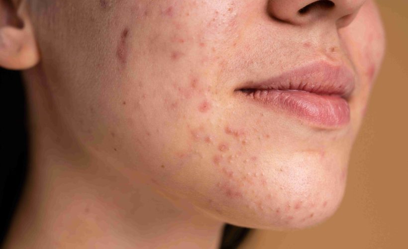 Pueraria Mirifica for Skin Pigmentation