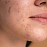 Pueraria Mirifica for Skin Pigmentation